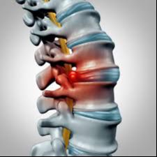 Herniated disc treated with DRX9000 spinal decompression