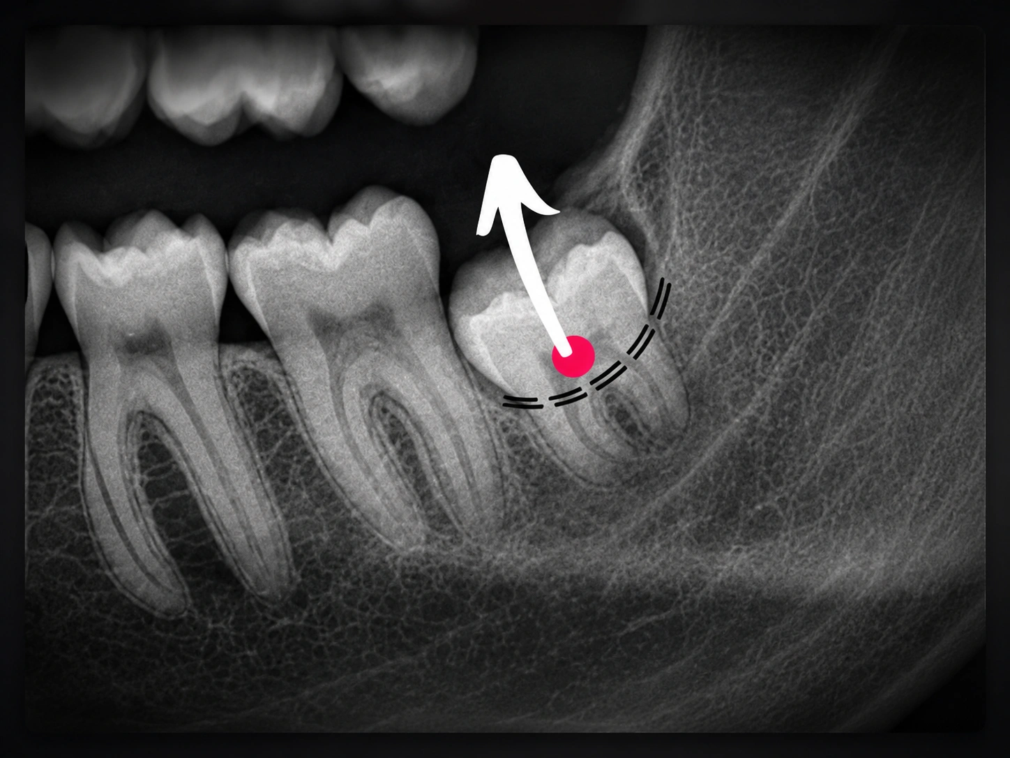 Third molars level 2 module image