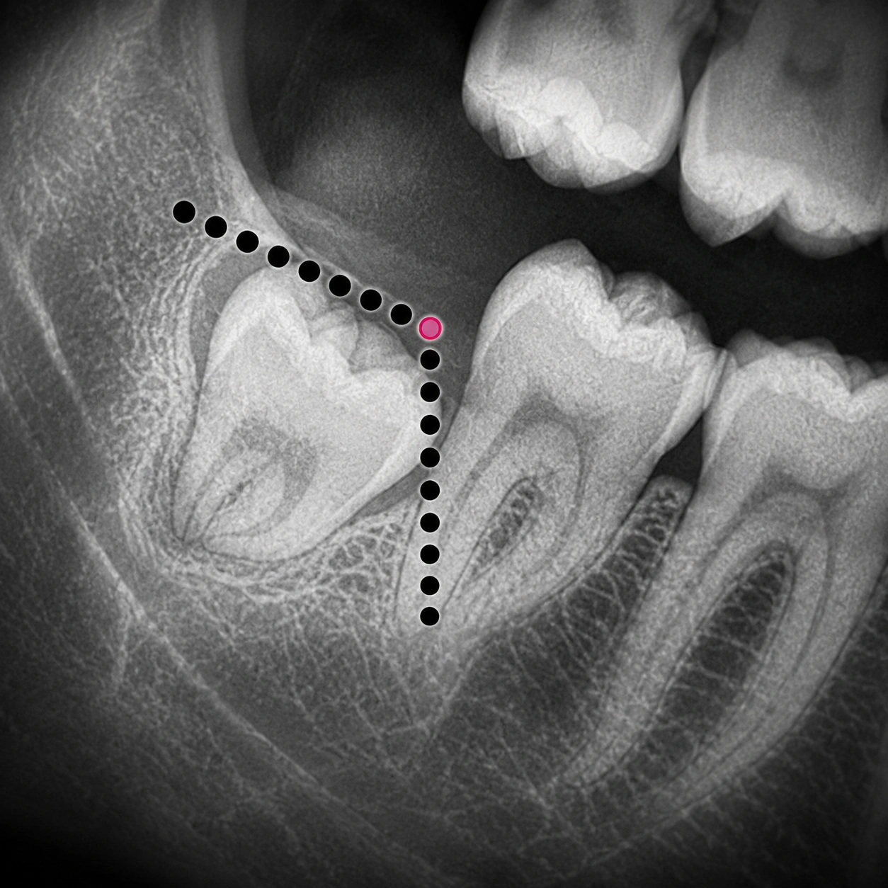 Third molars level 3 module image