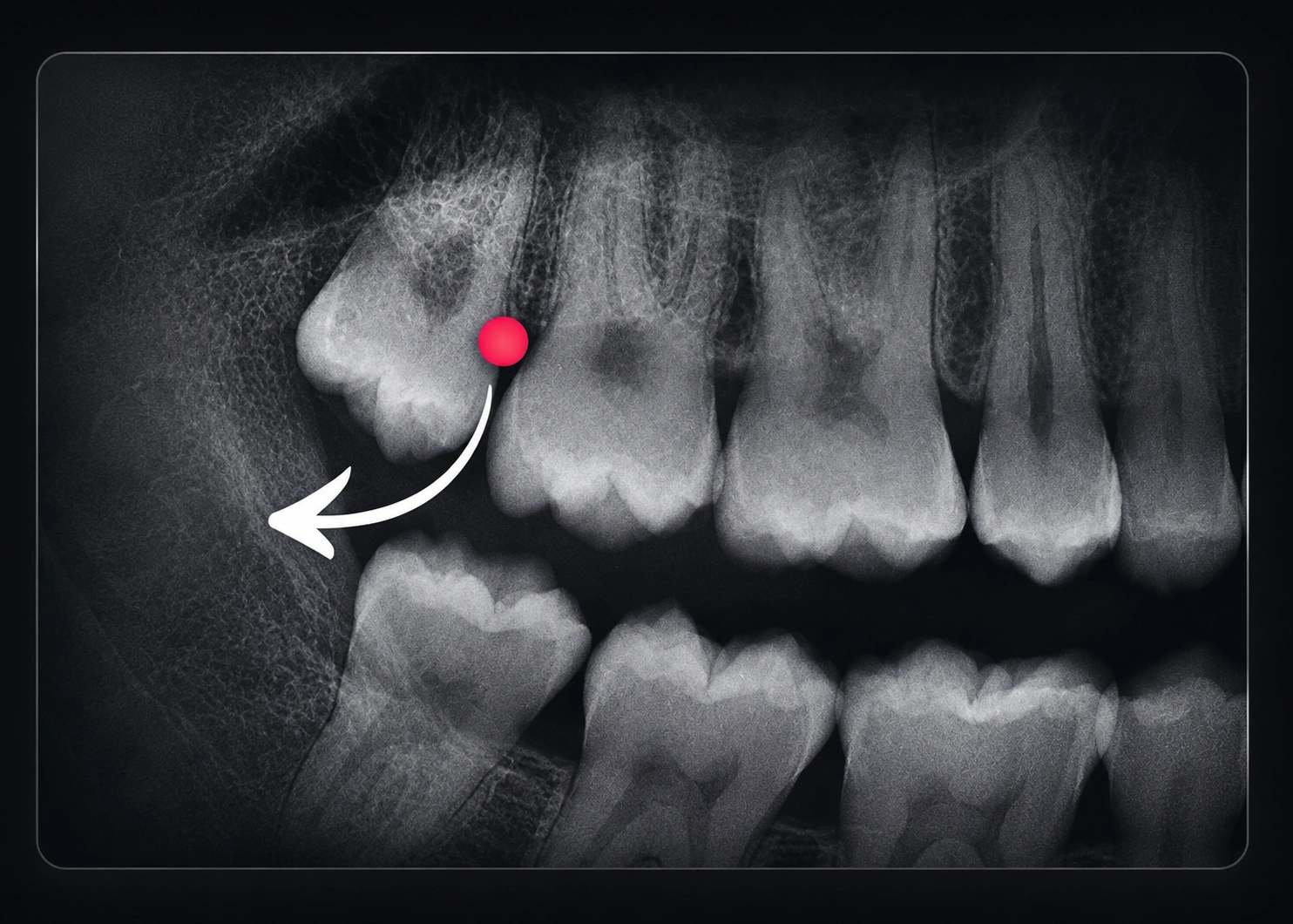 Third molars level 1 module image