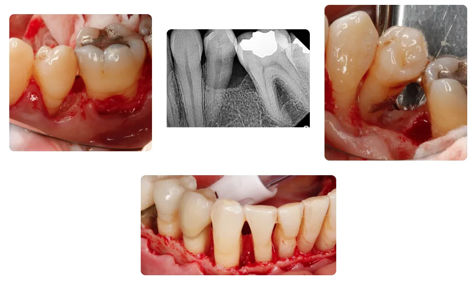 Periodontal surgery cases: a probe in a deep pocket, a radiograph of bone loss, a reflected flap exposing an osseous defect, and a full-thickness flap showing bone around the lower anterior teeth