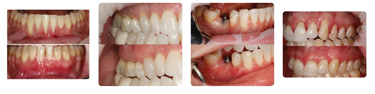 Before-and-after soft tissue grafting cases from Zeeba periodontists showing root coverage and gingival augmentation results