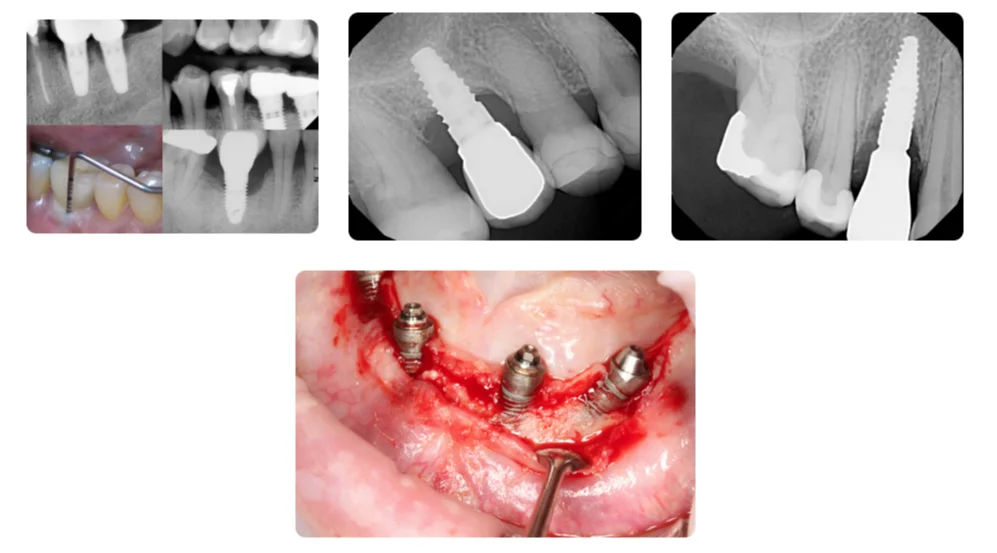 Peri-implantitis cases: radiographs showing bone loss around implants, probing of an inflamed peri-implant site, and a surgical flap exposing peri-implant defects around three implants