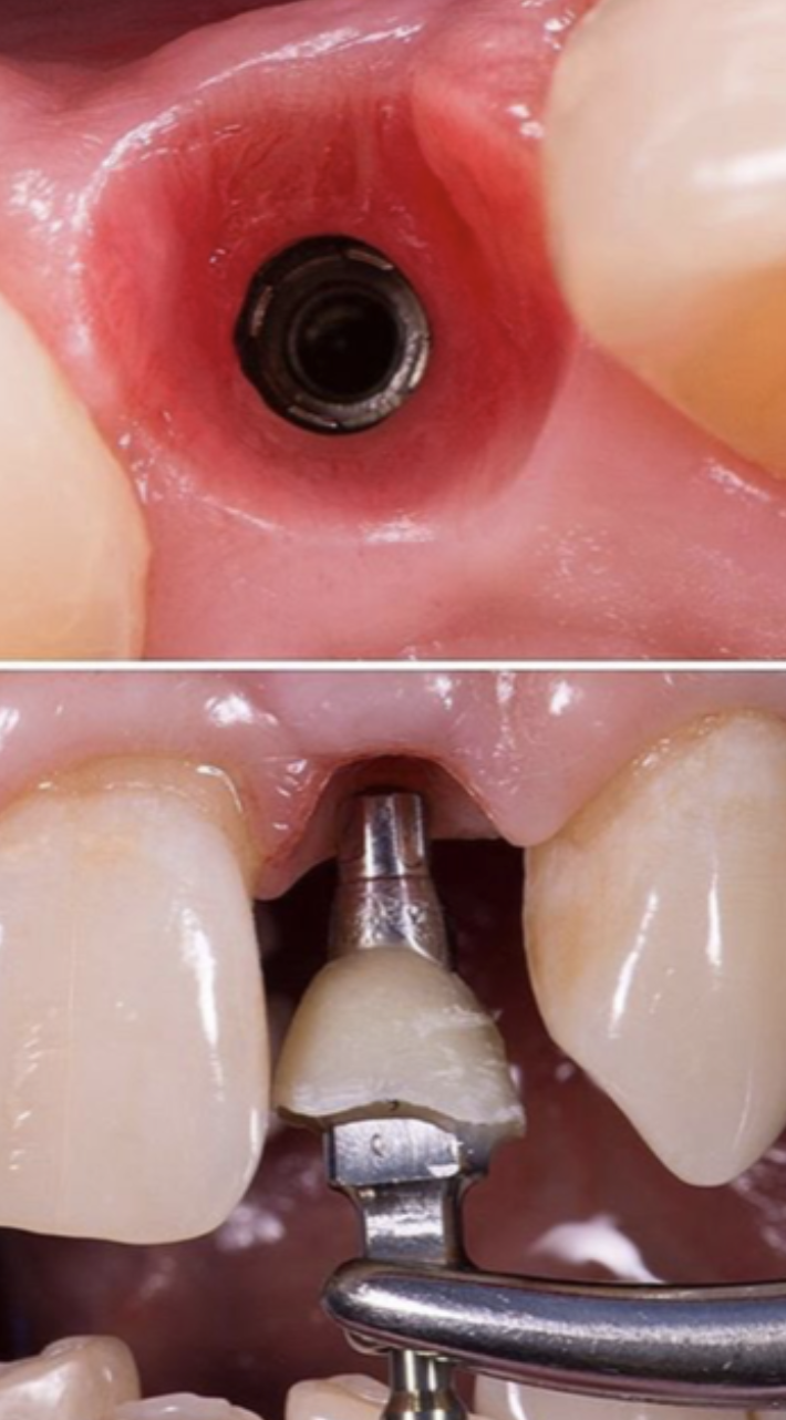 Implant Temporization Workshop