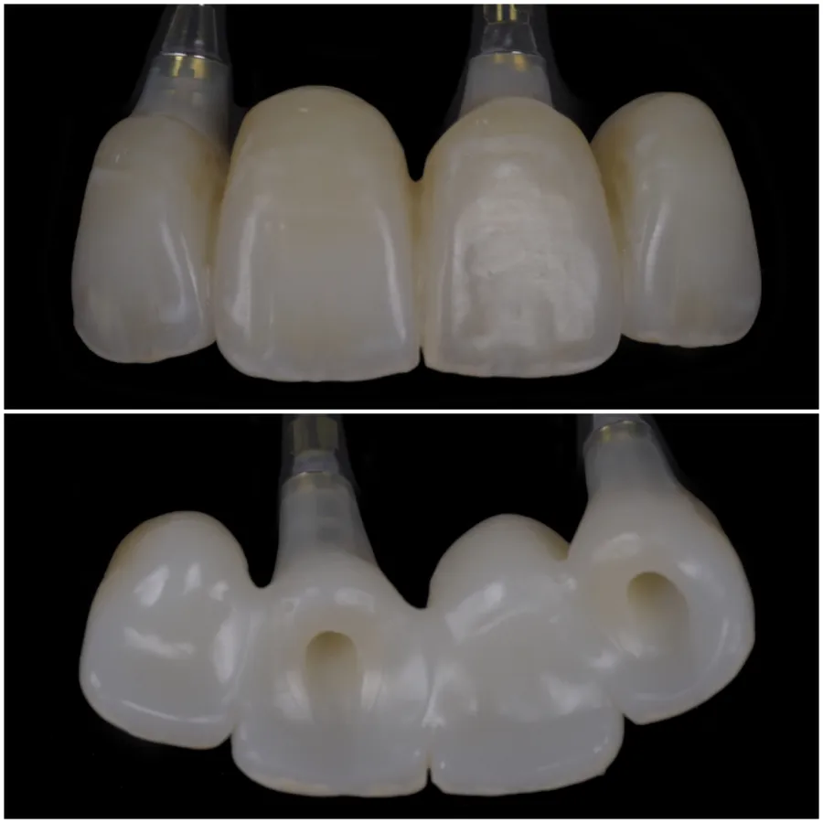 Four screw-retained implant provisional crowns for the anterior maxilla, shown from the facial side and the tissue side