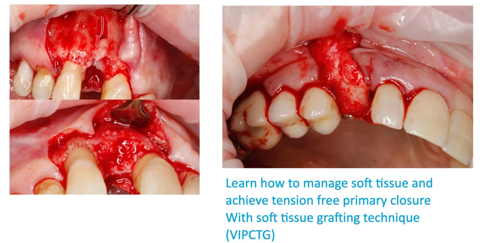 Clinical case series: guided bone regeneration and tension-free primary closure using the VIPCTG soft tissue grafting technique