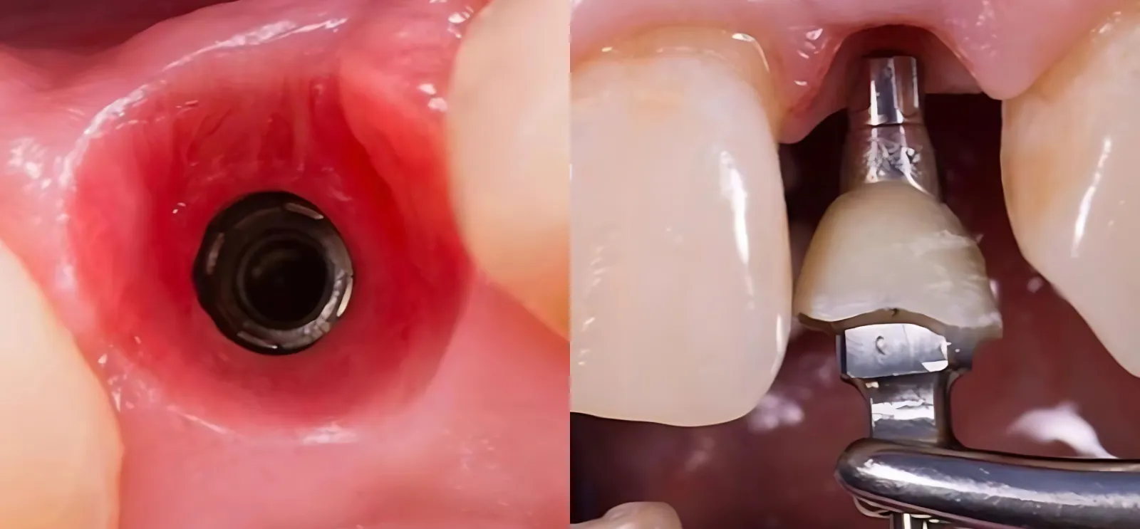 Left: a shaped peri-implant soft-tissue emergence profile around an anterior implant. Right: a custom screw-retained provisional crown being seated on the implant.