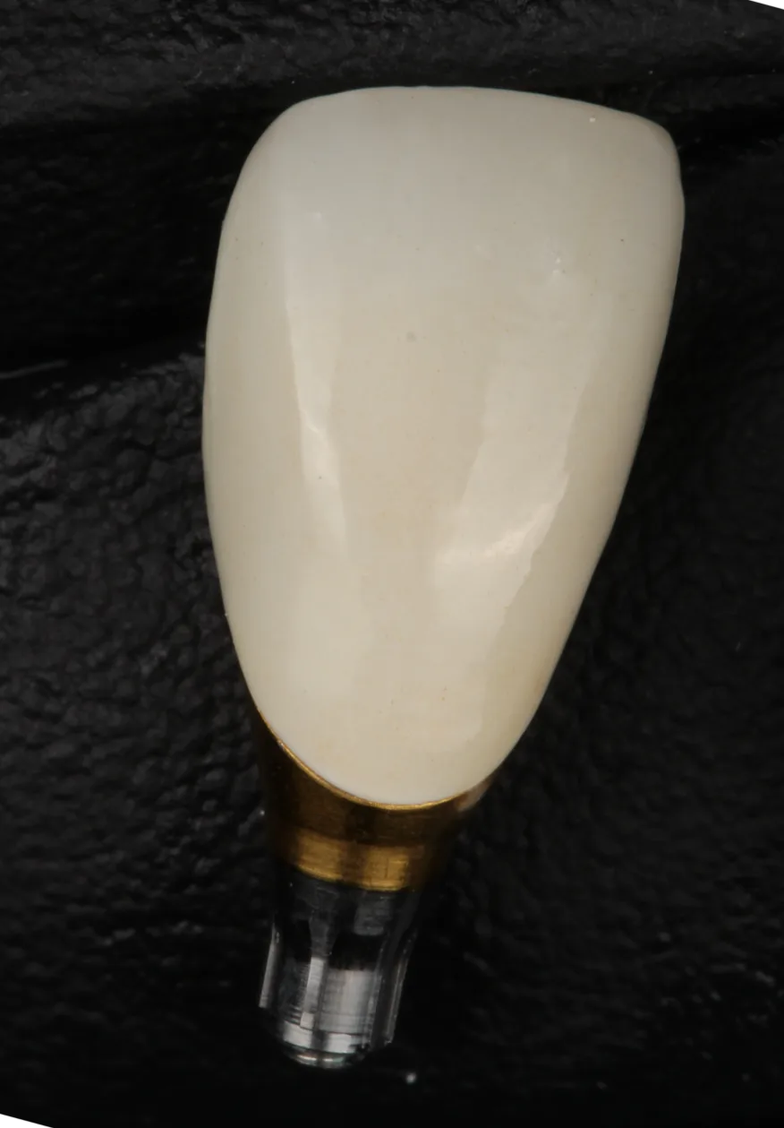 A single screw-retained implant crown on a titanium base, ready for delivery