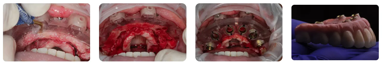 Full-arch implant surgery sequence: a pinned surgical guide on the maxilla, the ridge after bone reduction, implants placed through a stackable guide, and the finished implant-supported full-arch prosthesis