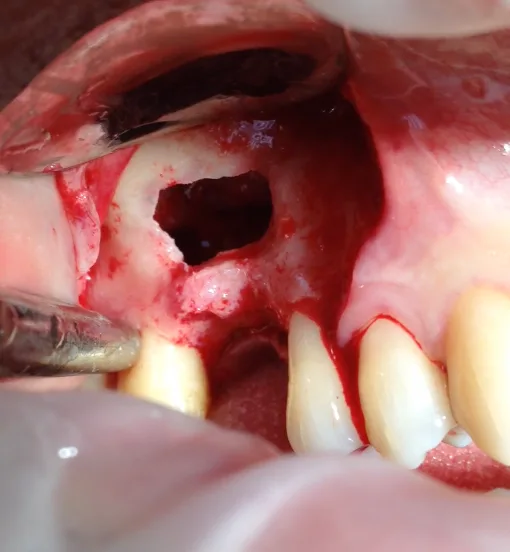 Lateral window sinus augmentation: a bony window opened in the posterior maxilla exposing the sinus membrane