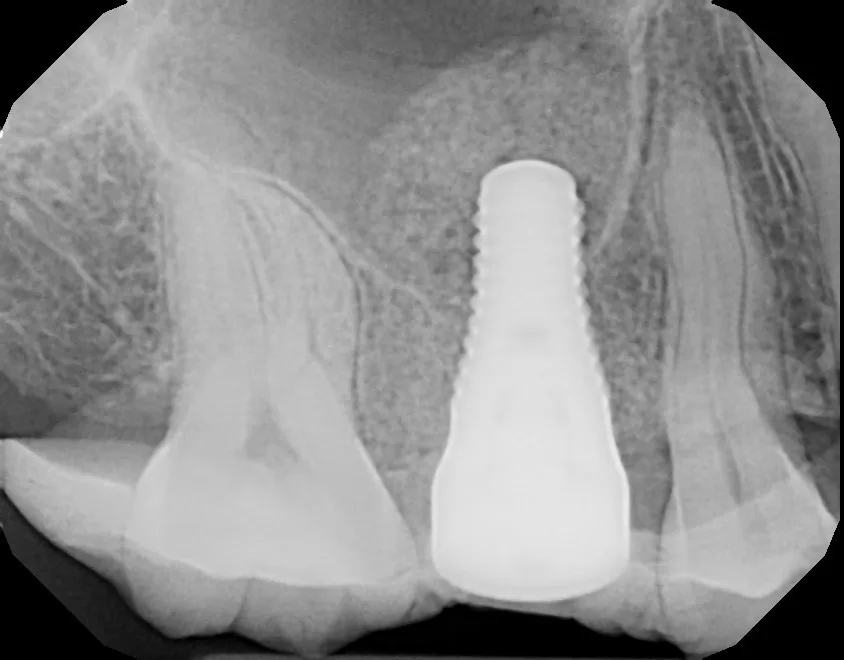 Radiograph of an implant in the posterior maxilla with grafted bone beneath the sinus floor