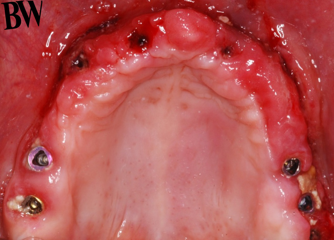 Implant Temporization Workshop — participant practice