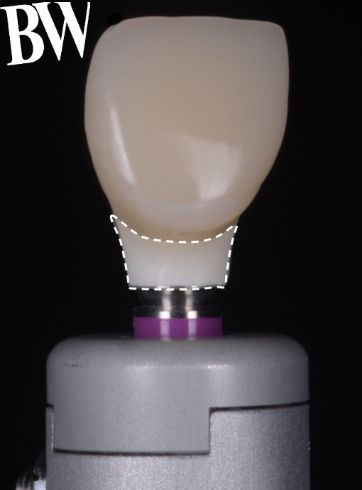 Implant Temporization Workshop — clinical demonstration