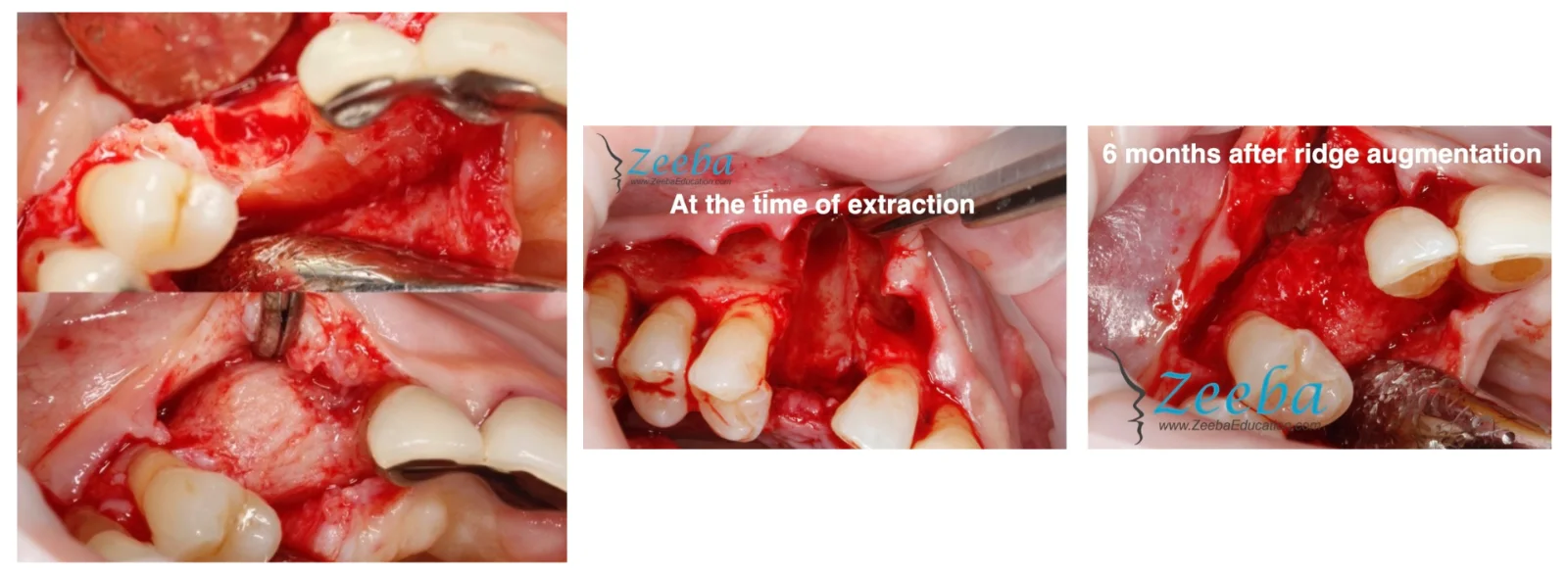 Clinical case series: ridge preservation at the time of extraction and the result months after ridge augmentation