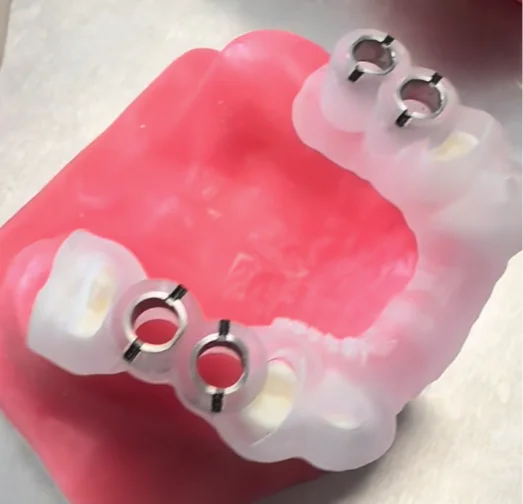 A surgical guide with metal drill sleeves seated on a dental model