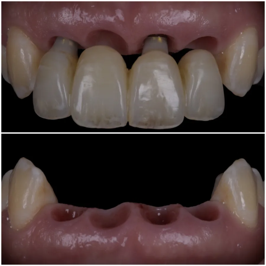 Anterior implant provisionals in place (top) and the shaped peri-implant soft tissue after the provisionals are removed (bottom)