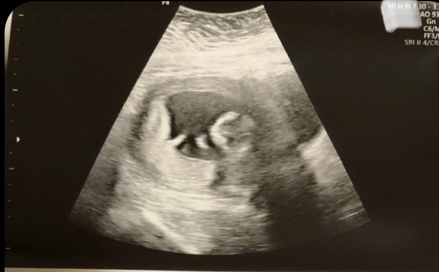 A 14-week ultrasound