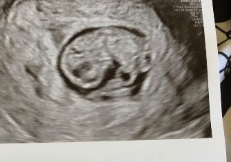 An ultrasound showing a strong heartbeat