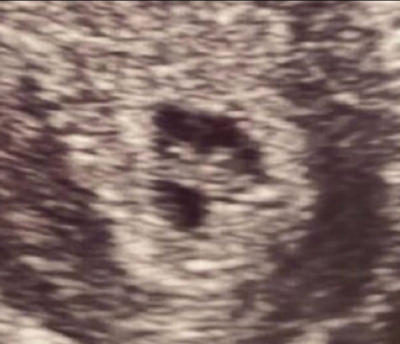 An early ultrasound