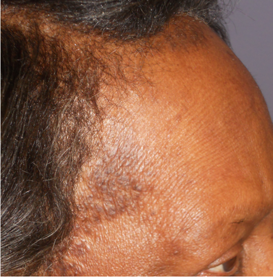 A closer look at a hair and scalp discovery